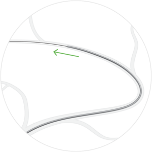 ProTrack Microcatheter over a guidewire in distal vasculature