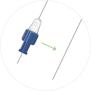 ProTrack Microcatheter with hub on the arrow pointing to it removed below